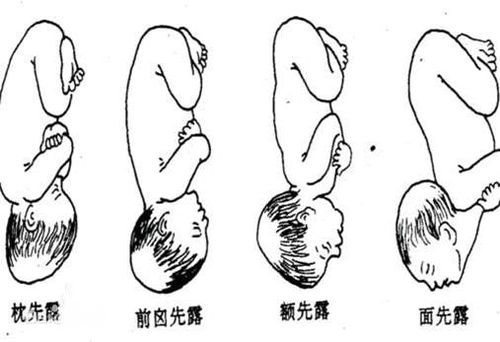 頭先露