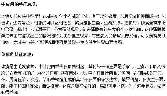 怎樣通過臨床表現(xiàn)來辨別牛皮癬和體癬