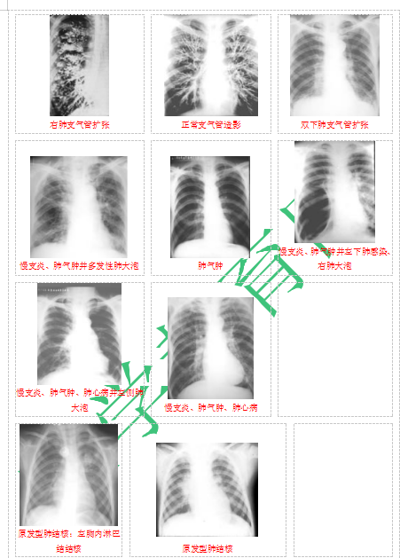 快收藏！臨床助理醫(yī)師實(shí)踐技能62個(gè)胸片（圖片診斷）